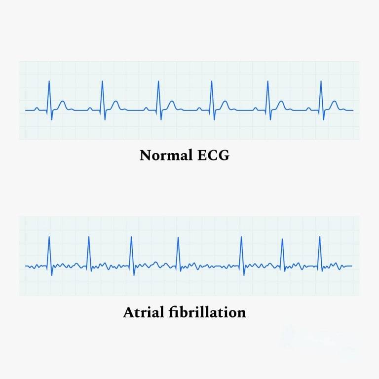Atrial Fibrillation Symptoms How Do You Know If You Have AFib Wellue Atrial Fibrillation Symptoms How Do You Know If You Have AFib Wellue
